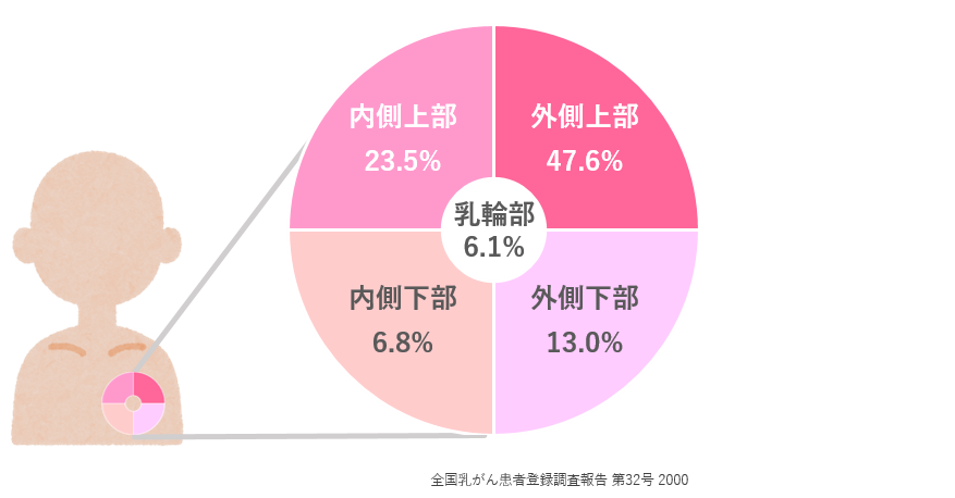 乳がん発生場所